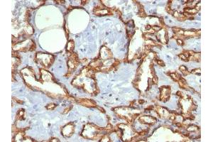 Formalin-fixed, paraffin-embedded human Angiosarcoma stained with CD31 Mouse Monoclonal Antibody (C31. (CD31 antibody)