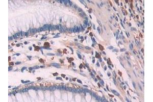 IHC-P analysis of Human Colorectal cancer Tissue, with DAB staining. (OAS1 antibody  (AA 74-165))