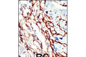 Formalin-fixed and paraffin-embedded human cancer tissue reacted with the primary antibody, which was peroxidase-conjugated to the secondary antibody, followed by AEC staining. (EPH Receptor A7 antibody  (C-Term))