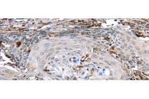 Immunohistochemistry of paraffin-embedded Human cervical cancer using TBXA2R Polyclonal Antibody at dilution of 1/40