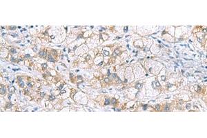 Immunohistochemistry of paraffin-embedded Human liver cancer tissue using GCSH Polyclonal Antibody at dilution of 1:60(x200) (GCSH antibody)
