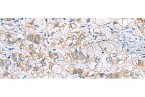 Immunohistochemistry of paraffin-embedded Human liver cancer tissue using GCSH Polyclonal Antibody at dilution of 1:60(x200)