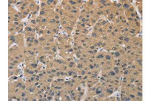 The image on the left is immunohistochemistry of paraffin-embedded Human liver cancer tissue using ABIN7129118(CYFIP2 Antibody) at dilution 1/25, on the right is treated with fusion protein. (CYFIP2 antibody)