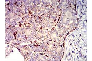 Immunohistochemical analysis of paraffin-embedded cervical cancer tissues using CD182 mouse mAb with DAB staining. (CXCR2 antibody)