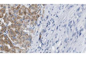 ABIN6274214 at 1/100 staining Human liver cancer tissue by IHC-P.