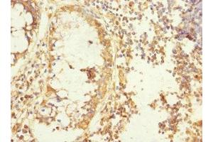 Immunohistochemistry of paraffin-embedded human colon cancer using ABIN7165806 at dilution of 1:100 (MEMO1 antibody  (AA 1-297))