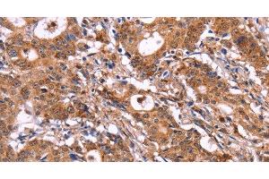 Immunohistochemistry of paraffin-embedded Human gastic cancer using SIGLEC5 Polyclonal Antibody at dilution of 1:30 (SIGLEC5 antibody)