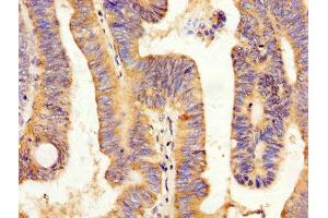 IHC image of ABIN7162770 diluted at 1:200 and staining in paraffin-embedded human colon cancer performed on a Leica BondTM system. (Peptide YY antibody  (AA 31-64))