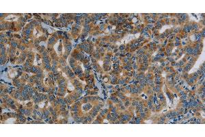 Immunohistochemistry of paraffin-embedded Human thyroid cancer tissue using PPARGC1B Polyclonal Antibody at dilution 1:30 (PPARGC1B antibody)