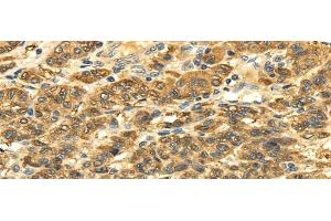 Immunohistochemistry of paraffin-embedded Human liver cancer tissue using SLC6A19 Polyclonal Antibody at dilution 1:35 (SLC6A19 antibody)