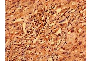 Immunohistochemistry analysis of human lung cancer using ABIN7176355 at dilution of 1:100 (ZNF529 antibody  (AA 393-563))