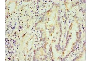 Immunohistochemistry of paraffin-embedded human lung cancer using ABIN7171237 at dilution of 1: 100 (STX3 antibody  (AA 1-263))