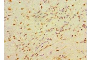 Immunohistochemistry of paraffin-embedded human breast cancer using ABIN7146714 at dilution of 1:100 (CA14 antibody  (AA 16-290))