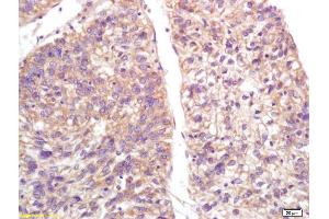 Formalin-fixed and paraffin embedded human lung carcinoma labeled with Anti-S100-A9/MRP14/CFAG/Calgranulin B Polyclonal Antibody, Unconjugated (ABIN749288) at 1:200, followed by conjugation to the secondary antibody and DAB staining (S100A9 antibody  (AA 51-114))