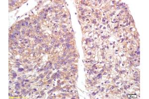 Formalin-fixed and paraffin embedded human lung carcinoma labeled with Anti-S100-A9/MRP14/CFAG/Calgranulin B Polyclonal Antibody, Unconjugated (ABIN749288) at 1:200, followed by conjugation to the secondary antibody and DAB staining (S100A9 antibody  (AA 51-114))