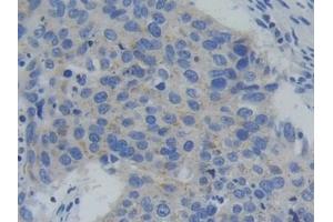 Detection of PFKP in Human Lung cancer Tissue using Polyclonal Antibody to Phosphofructokinase, Platelet (PFKP) (PFKP antibody  (AA 553-753))