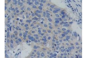Detection of PFKP in Human Lung cancer Tissue using Polyclonal Antibody to Phosphofructokinase, Platelet (PFKP)