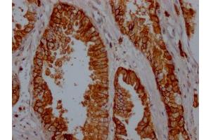 IHC image of ABIN7127402 diluted at 1:100 and staining in paraffin-embedded human prostate cancer performed on a Leica BondTM system. (Recombinant CD38 antibody)