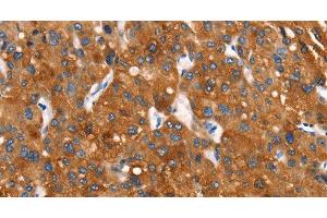Immunohistochemistry of paraffin-embedded Human liver cancer tissue using Cytochrome b Polyclonal Antibody at dilution 1:30 (Cytochrome b antibody)