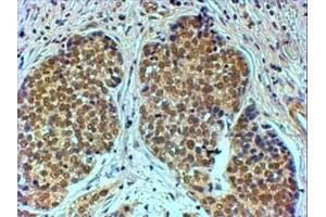 IHC testing of FFPE human breast cancer with TIF1A antibody at 4ug/ml. (TRIM24 antibody)
