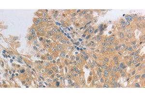Immunohistochemistry of paraffin-embedded Human ovarian cancer tissue using HCRTR2 Polyclonal Antibody at dilution 1:50 (HCRTR2 antibody)