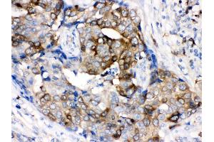 nti- Stathmin 1 Picoband antibody, IHC(P) IHC(P): Human Mammary Cancer Tissue (Stathmin 1 antibody  (N-Term))