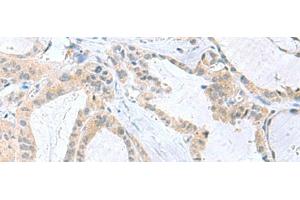 Immunohistochemistry of paraffin-embedded Human thyroid cancer tissue using PDE6D Polyclonal Antibody at dilution of 1:50(x200) (PDE6D antibody)