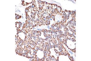 Immunohistochemistry of paraffin-embedded human liver cancer using GABA transaminase (GABA transaminase (ABAT)) Rabbit mAb (ABIN7265336) at dilution of 1:100 (40x lens). (ABAT antibody)