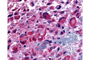 Anti-CHRM2 / M2 antibody IHC of human Brain, Glioblastoma. (Muscarinic Acetylcholine Receptor M2 antibody  (Cytoplasmic Domain))