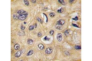 IHC analysis of FFPE human hepatocarcinoma tissue stained with Tuberin antibody (Tuberin antibody  (AA 1776-1805))