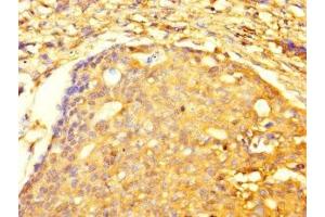 Immunohistochemistry of paraffin-embedded human gastric cancer using ABIN7173479 at dilution of 1:100 (TRIM74 antibody  (AA 47-249))