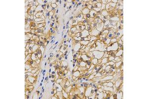 Immunohistochemistry of paraffin-embedded human stomach cancer using GRIA1 antibody at dilution of 1:200 (x400 lens) (Glutamate Receptor 1 antibody  (AA 19-300))
