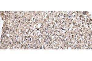 Immunohistochemistry of paraffin-embedded Human lung cancer tissue using METAP1D Polyclonal Antibody at dilution of 1:60(x200)