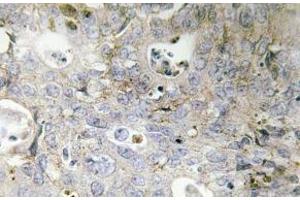 Immunohistochemistry (IHC) analyzes of Laminin gamma-1 antibody in paraffin-embedded human colon carcinoma tissue. (Laminin gamma 1 antibody)