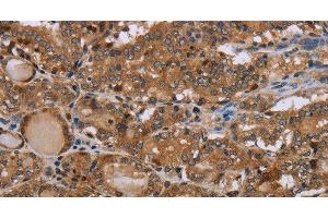 Immunohistochemistry of paraffin-embedded Human thyroid cancer using MT-ND1 Polyclonal Antibody at dilution of 1:50 (MT-ND1 antibody)