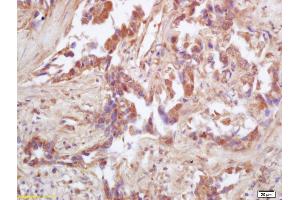 Formalin-fixed and paraffin embedded human lung carcinoma labeled with Rabbit Anti IDH2 Polyclonal Antibody, Unconjugated (ABIN751558) at 1:200 followed by conjugation to the secondary antibody and DAB staining (IDH2 antibody  (AA 251-350))