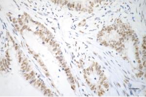 Immunohistochemistry was performed on paraffin-embedded human sigmoid colon carcinoma using USP39 antibody (ABIN7800735), 1:200).