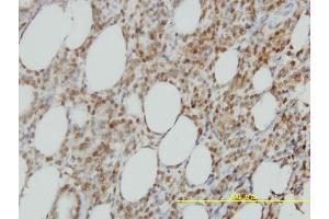 Immunoperoxidase of monoclonal antibody to ISGF3G on formalin-fixed paraffin-embedded human malignant lymphoma, diffuse large B tissue. (IRF9 antibody  (AA 1-393))