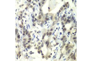 Immunohistochemistry of paraffin-embedded human gastric cancer using E2F6 antibody. (E2F6 antibody)