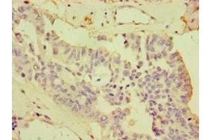 Immunohistochemistry of paraffin-embedded human endometrial cancer using ABIN7148730 at dilution of 1:100 (CDCP1 antibody  (AA 523-836))