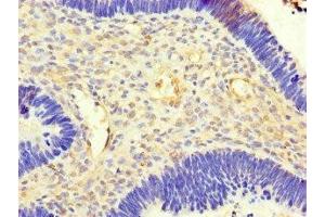 Immunohistochemistry of paraffin-embedded human ovarian cancer using ABIN7143204 at dilution of 1:100