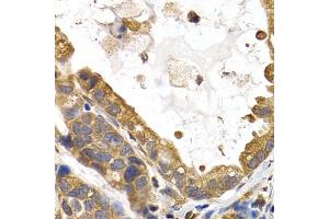 Immunohistochemistry of paraffin-embedded human stomach cancer using GYS1 antibody (ABIN5971351) at dilution of 1/200 (40x lens). (Glycogen Synthase 1 antibody)