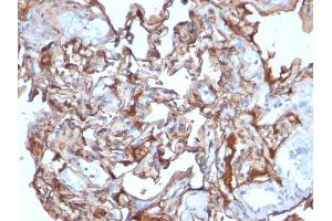 Formalin-fixed, paraffin-embedded human Melanoma stained with MCAM Mouse Monoclonal Antibody (MCAM/1101). (MCAM antibody)