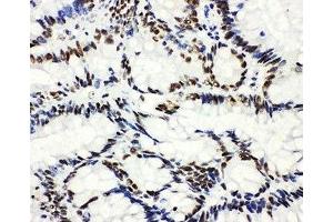 IHC-P: HDAC3 antibody testing of human intestinal cancer tissue (HDAC3 antibody  (AA 411-428))