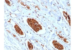 Formalin-fixed, paraffin-embedded human Angiosarcoma stained with Glycophorin A Mouse Recombinant Monoclonal Antibody (rGYPA/280). (Recombinant CD235a/GYPA antibody)