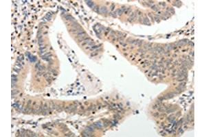 The image on the left is immunohistochemistry of paraffin-embedded Human colon cancer tissue using ABIN7189660(ADAMTS2 Antibody) at dilution 1/25, on the right is treated with synthetic peptide. (Adamts2 antibody)