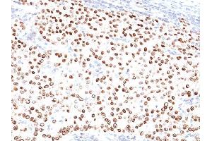 Formalin-fixed, paraffin-embedded human Breast Carcinoma stained with Progesterone Receptor Mouse Monoclonal Antibody (PR500). (Progesterone Receptor antibody)