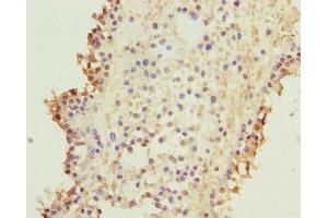 Immunohistochemistry of paraffin-embedded human breast cancer using ABIN7157640 at dilution of 1:100