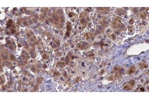 ABIN6276849 at 1/100 staining Human liver cancer tissue by IHC-P. (CHRNA5 antibody  (Internal Region))