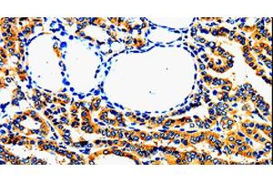 Immunohistochemistry of paraffin-embedded Human thyroid cancer using AIMP2 Polyclonal Antibody at dilution of 1:50 (AIMP2 antibody)